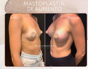 Aumento mamas - Dr. Juan Martín Saa