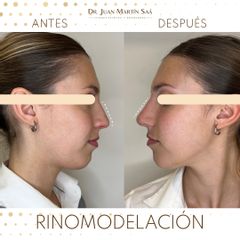 Rinomodelación  - Dr. Juan Martín Saa