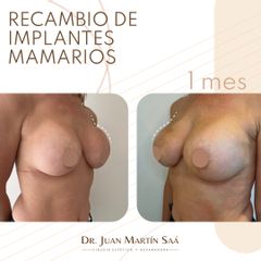 Recambio de prótesis - Dr. Juan Martín Saá