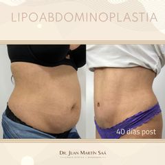 Lipoabdominoplastia - Dr. Juan Martín Saa