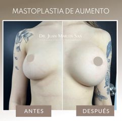 Aumento mamas  - Dr. Juan Martín Saá
