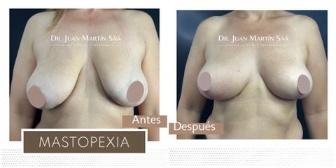 Mastopexia - Dr. Juan Martín Saá