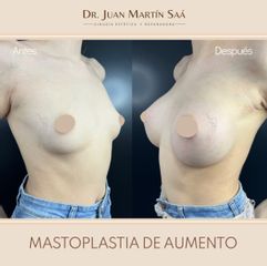 Aumento mamas - Dr. Juan Martín Saá
