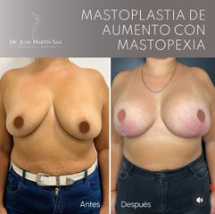 Mastoplastia de Aumento con Mastopexia - Dr. Juan Martin Saa