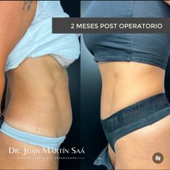 Mini Abdominoplastia - Dr. Juan Martin Saa