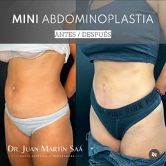 Mini Abdominoplastia - Dr. Juan Martin Saa