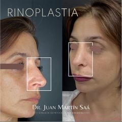 Rinoplastia - Dr. Juan Martin Saa