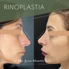 Rinoplastia - Dr. Juan Martin Saa