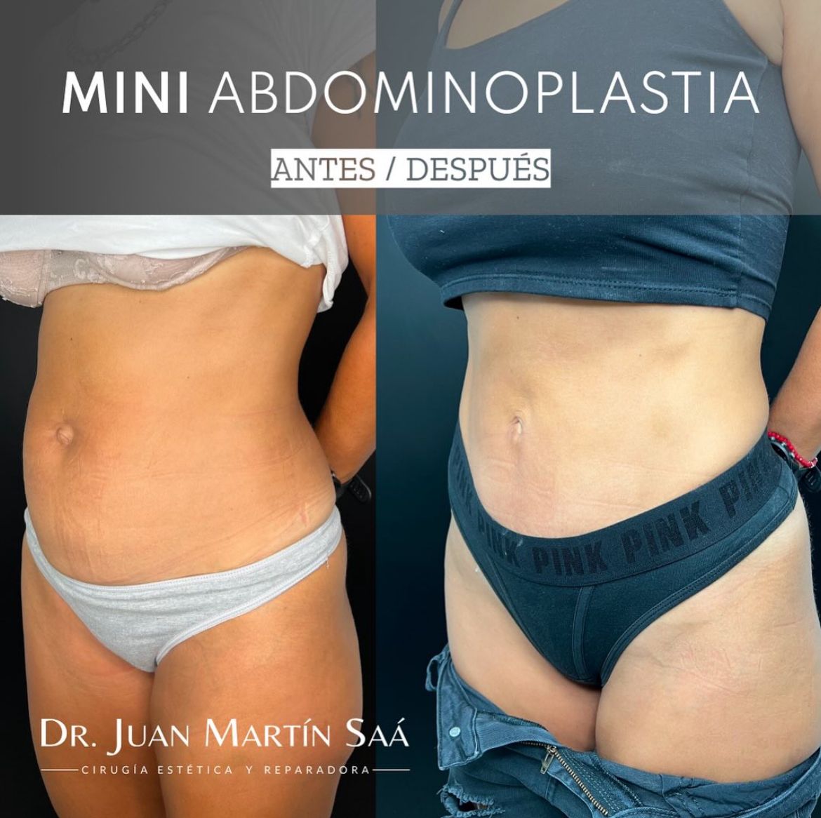 Antes y después - Esteticas.com.ar - Esteticas.com.ar