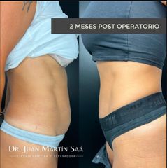 Mini abdominoplastia - Dr. Juan Martín Saá