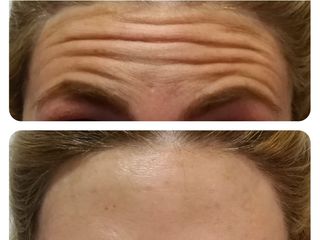 Botox - Rejuvenecimiento facial