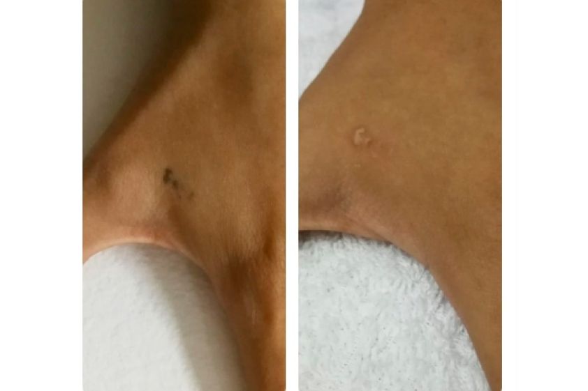 Borrar tatuajes antes y después - 634930