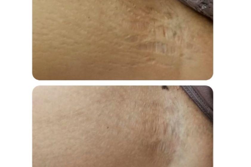 Tratamientos para estrías antes y después - 636097