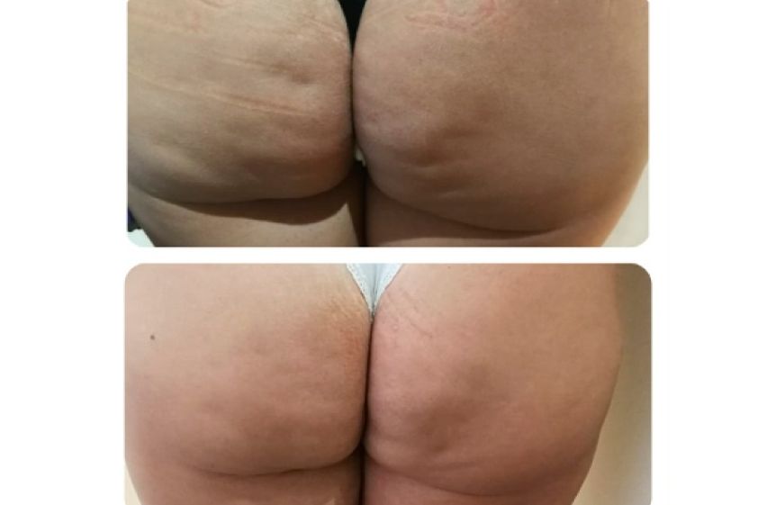 Tratamientos celulitis antes y después - 636099