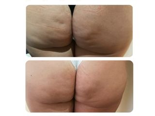 Subsición-para-celulitis