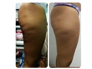 Subsición-para-celulitis