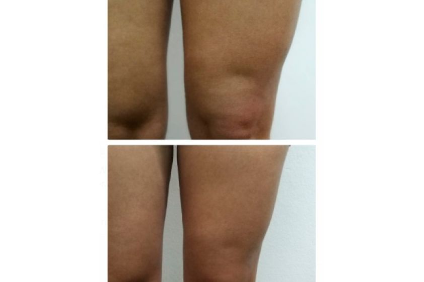 Tratamientos celulitis antes y después - 636102