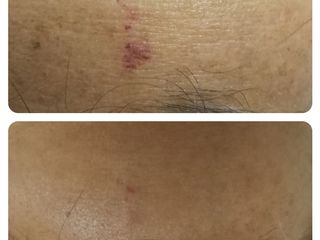 Manchas solares con Láser Harmony