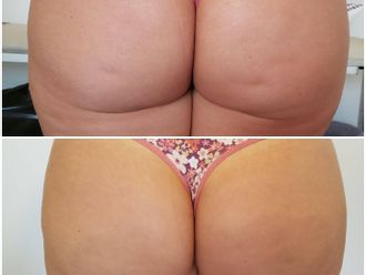 Tratamientos celulitis antes y después - 698956