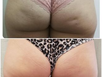 Tratamientos celulitis antes y después - 698957