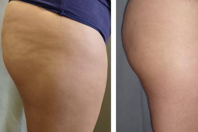 Tratamientos celulitis antes y después - 870580