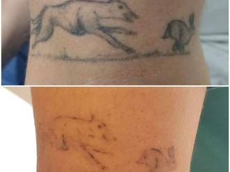 Borrar tatuajes antes y después - 870584