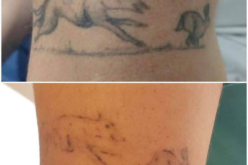 Borrar tatuajes antes y después - 870584