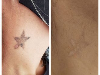 Borrar tatuajes antes y después - 870586