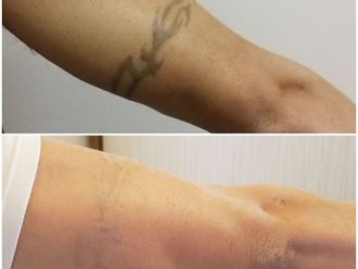 Borrar tatuajes antes y después - 870587