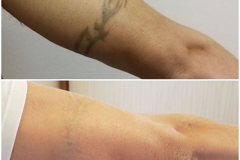 Borrar tatuajes antes y después - 870587