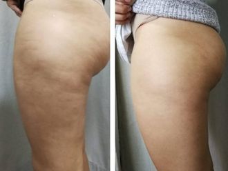 Tratamientos celulitis antes y después - 870592