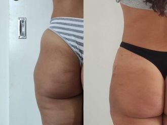 Tratamientos celulitis antes y después - 870593