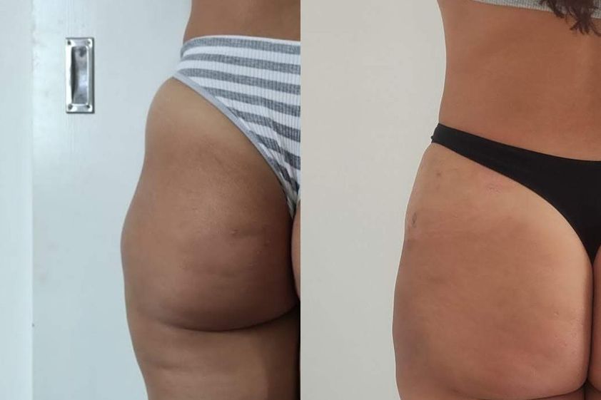 Tratamientos celulitis antes y después - 870593