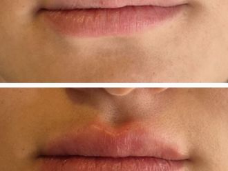 Relleno de labios antes y después - 870715