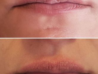 Relleno de labios antes y después - 870718