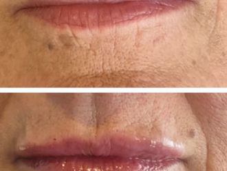 Relleno de labios antes y después - 870720