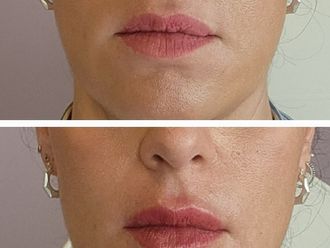 Relleno de labios antes y después - 870722