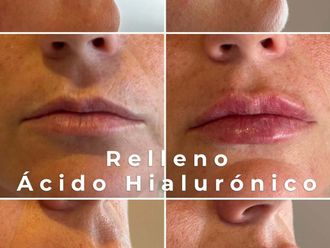 Relleno de labios antes y después - 876417