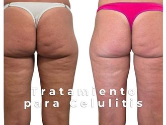 Tratamientos celulitis antes y después - 876418