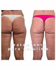 Tratamiento Celulitis - Medvital