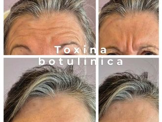 Botox antes y después - 876420