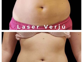 Tratamientos celulitis antes y después - 876421