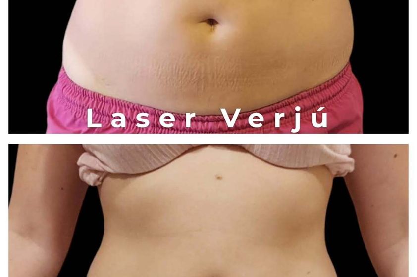Tratamientos celulitis antes y después - 876421