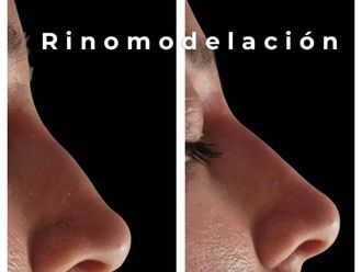 Rinomodelación antes y después - 876422