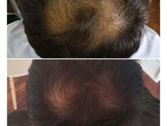 Plasma Rico en Plaquetas antes y después - 876423