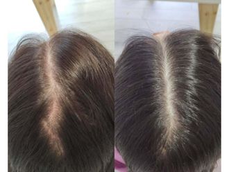 Plasma Rico en Plaquetas antes y después - 876424