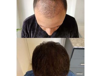 Plasma Rico en Plaquetas antes y después - 876425