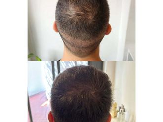 Plasma Rico en Plaquetas antes y después - 876426