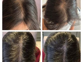 Plasma Rico en Plaquetas antes y después - 876427