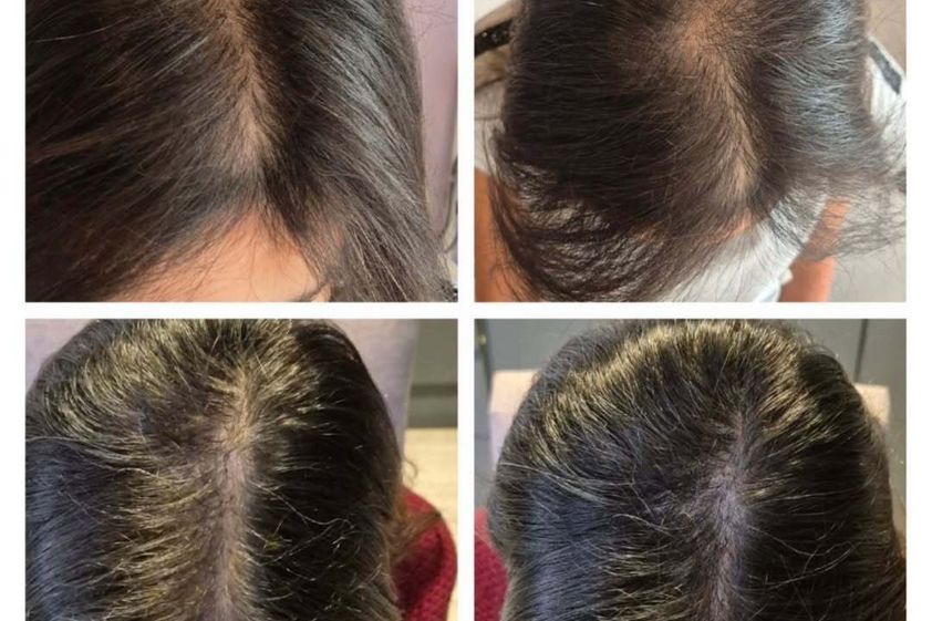 Plasma Rico en Plaquetas antes y después - 876427